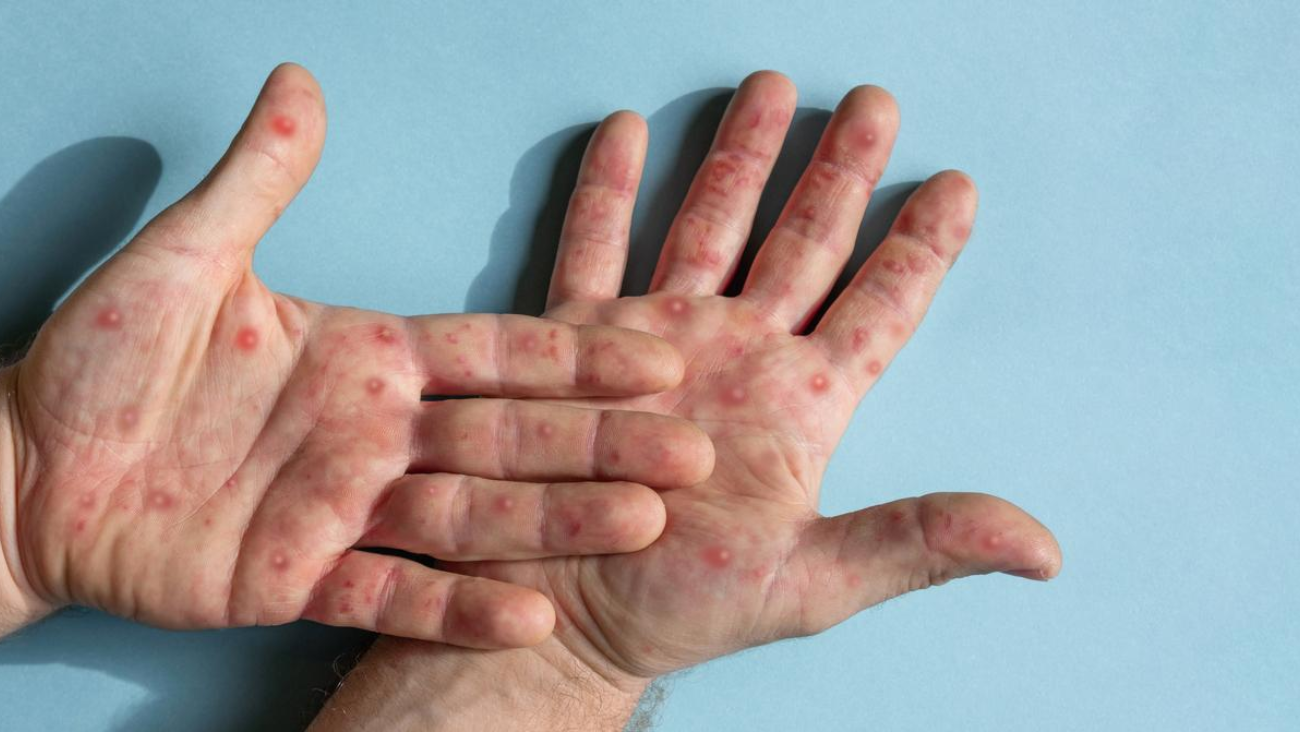 Un virus súper contagioso llega a Nueva York y causa estos peligrosos síntomas