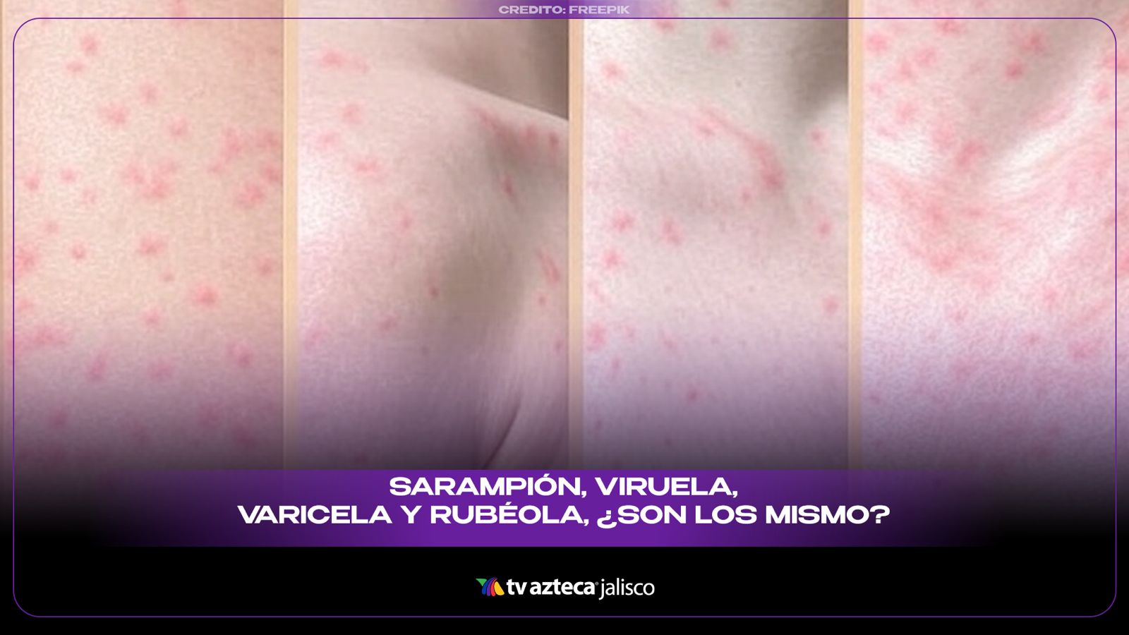 Sarampión, viruela, varicela y rubéola; ¿son lo mismo?