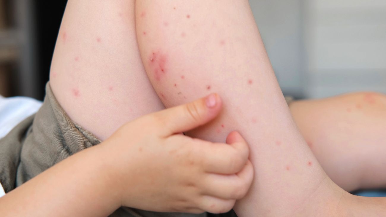 Detectan primer caso de sarampión en Puebla, piden usar cubrebocas en espacios públicos y cerrados