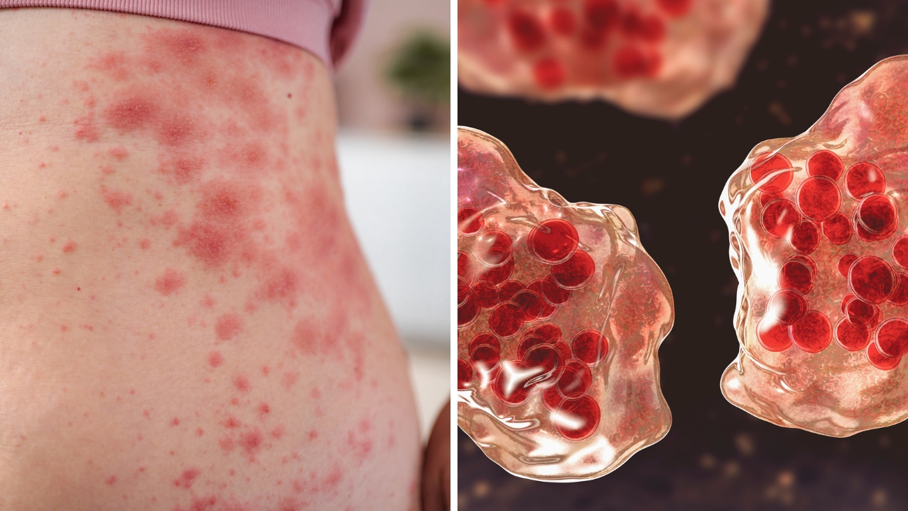 ¿Perdiste tu cartilla de vacunación? La prueba que confirma si tienes inmunidad contra el sarampión