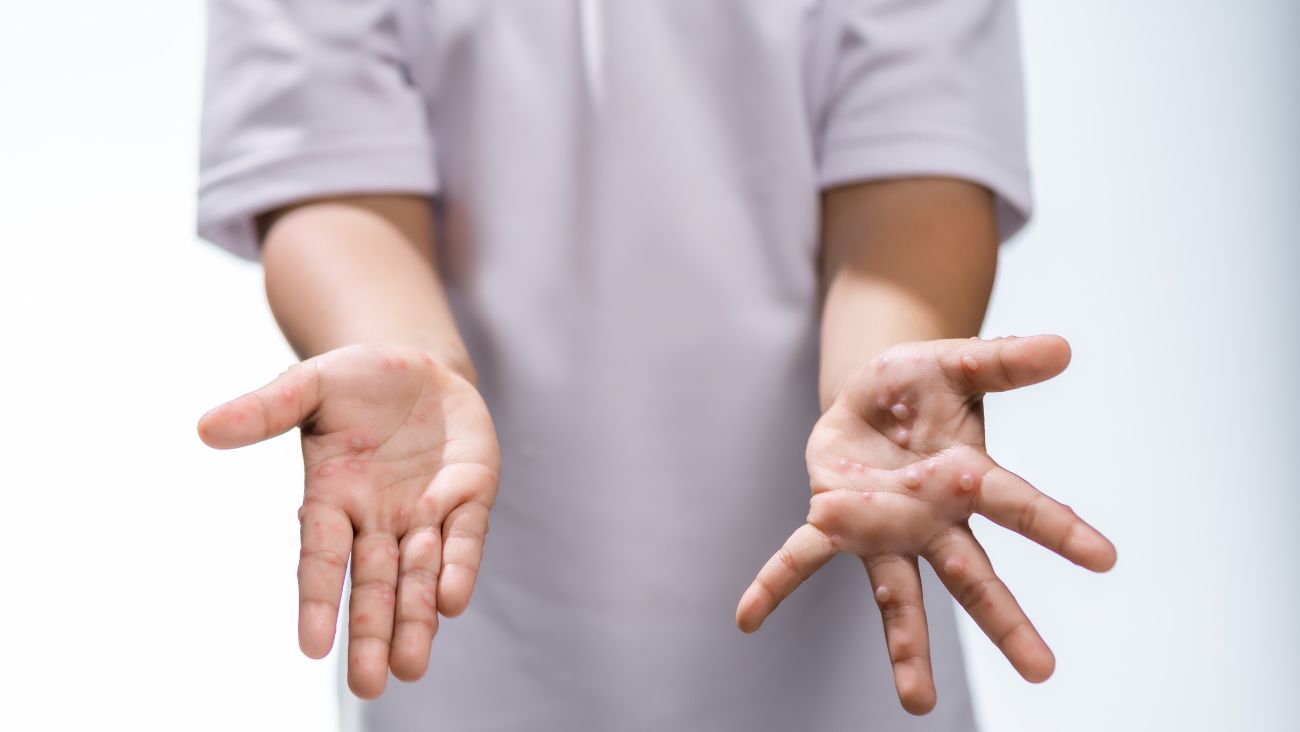 Lista de escuelas con más casos de sarampión en México por segundo brote