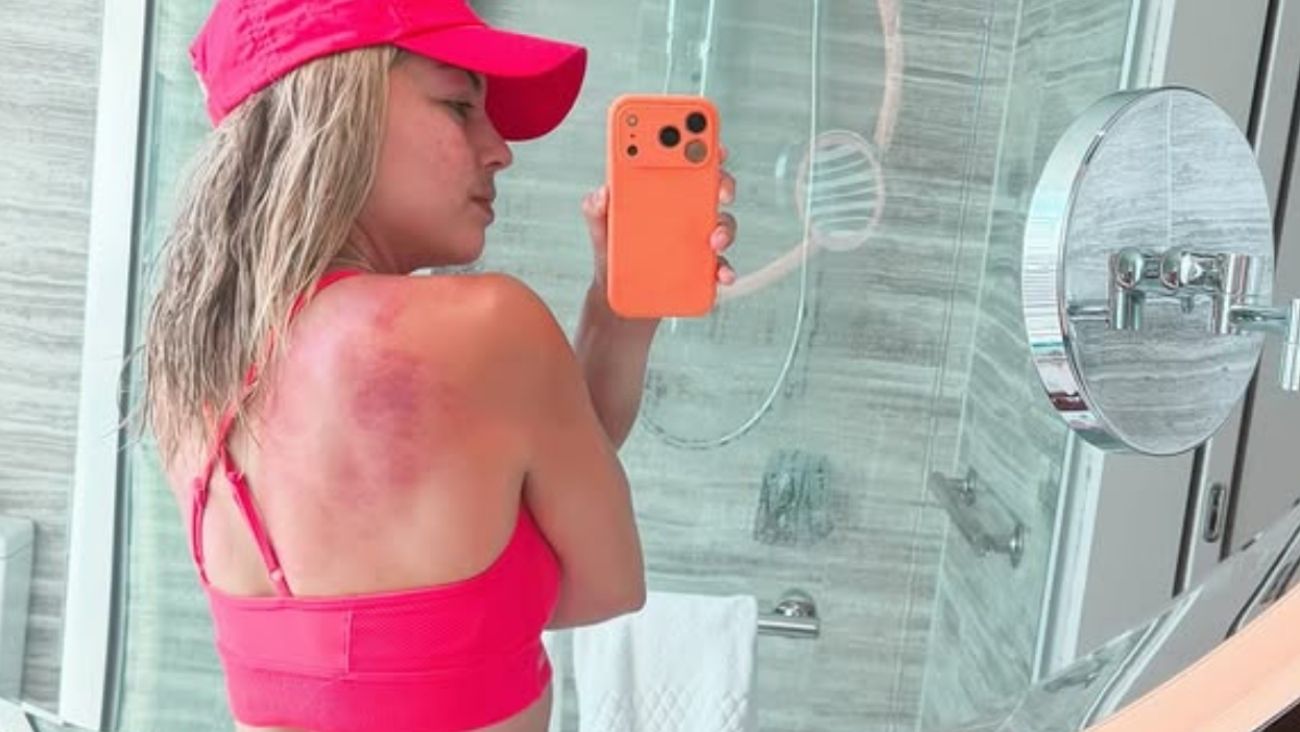 Renata Zarazúa termina con quemaduras en su espalda por el sol infernal en Australia