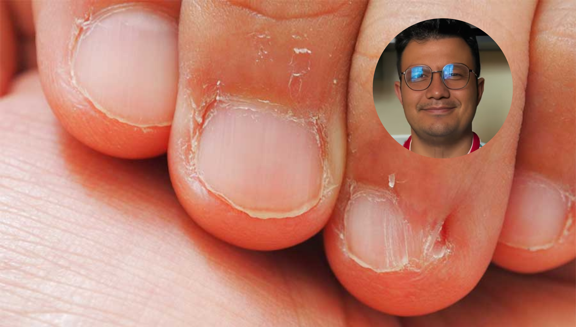 Influencer Luisito revela que tuvo cáncer en un dedo por comerse las uñas: ¿Cómo pasó?