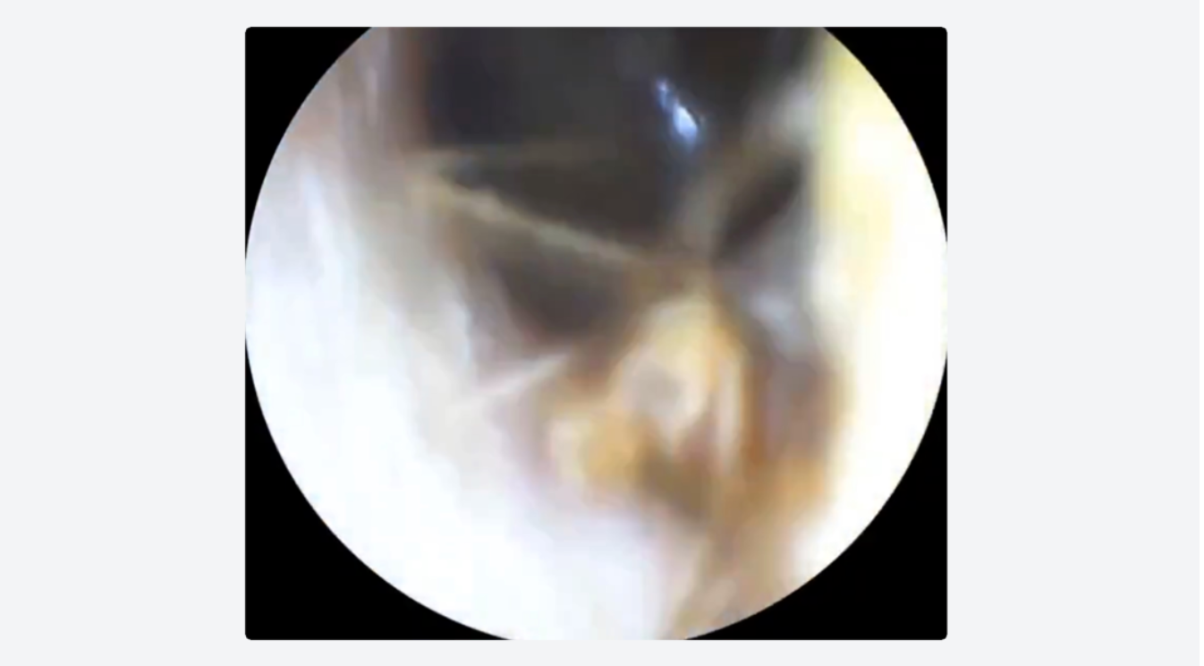 VIDEO: Una araña fue encontrada en el oído de una mujer, tenía una semana viviendo ahí