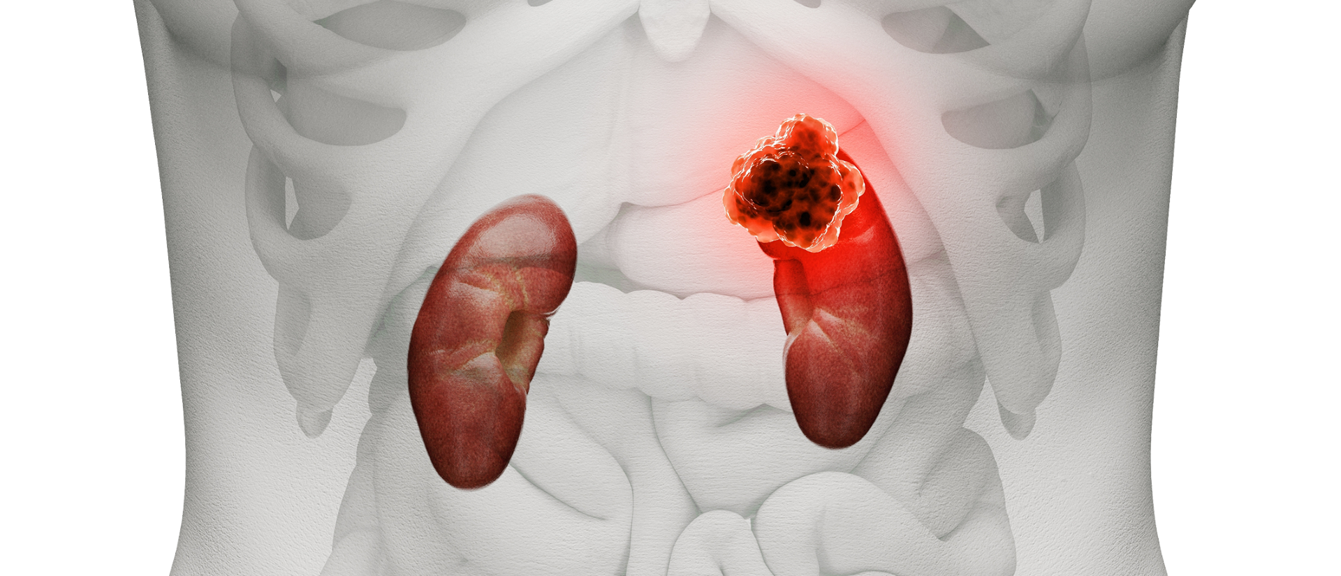 Cáncer Renal: Una enfermedad compleja y silenciosa