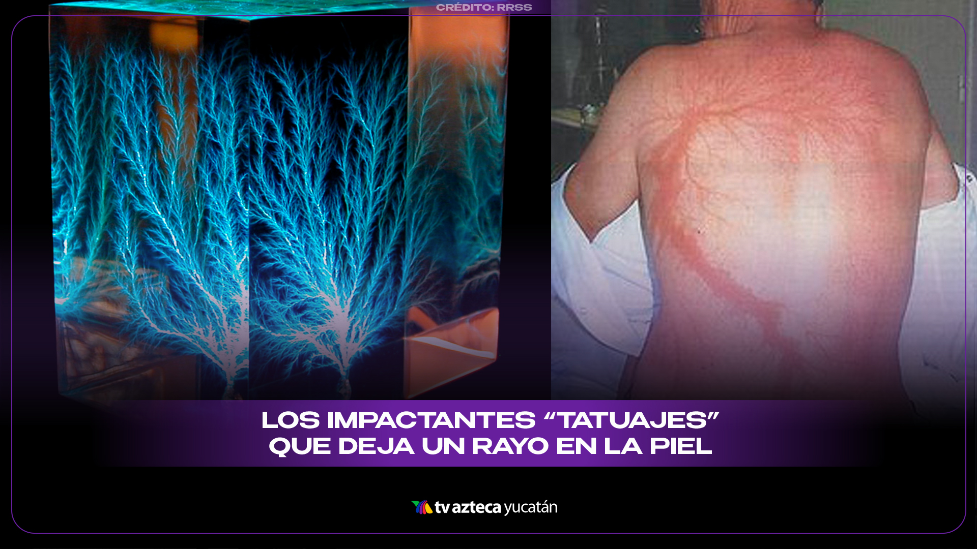 Figuras de Lichtenberg: ¿Qué son y por qué aparecen en la piel tras el