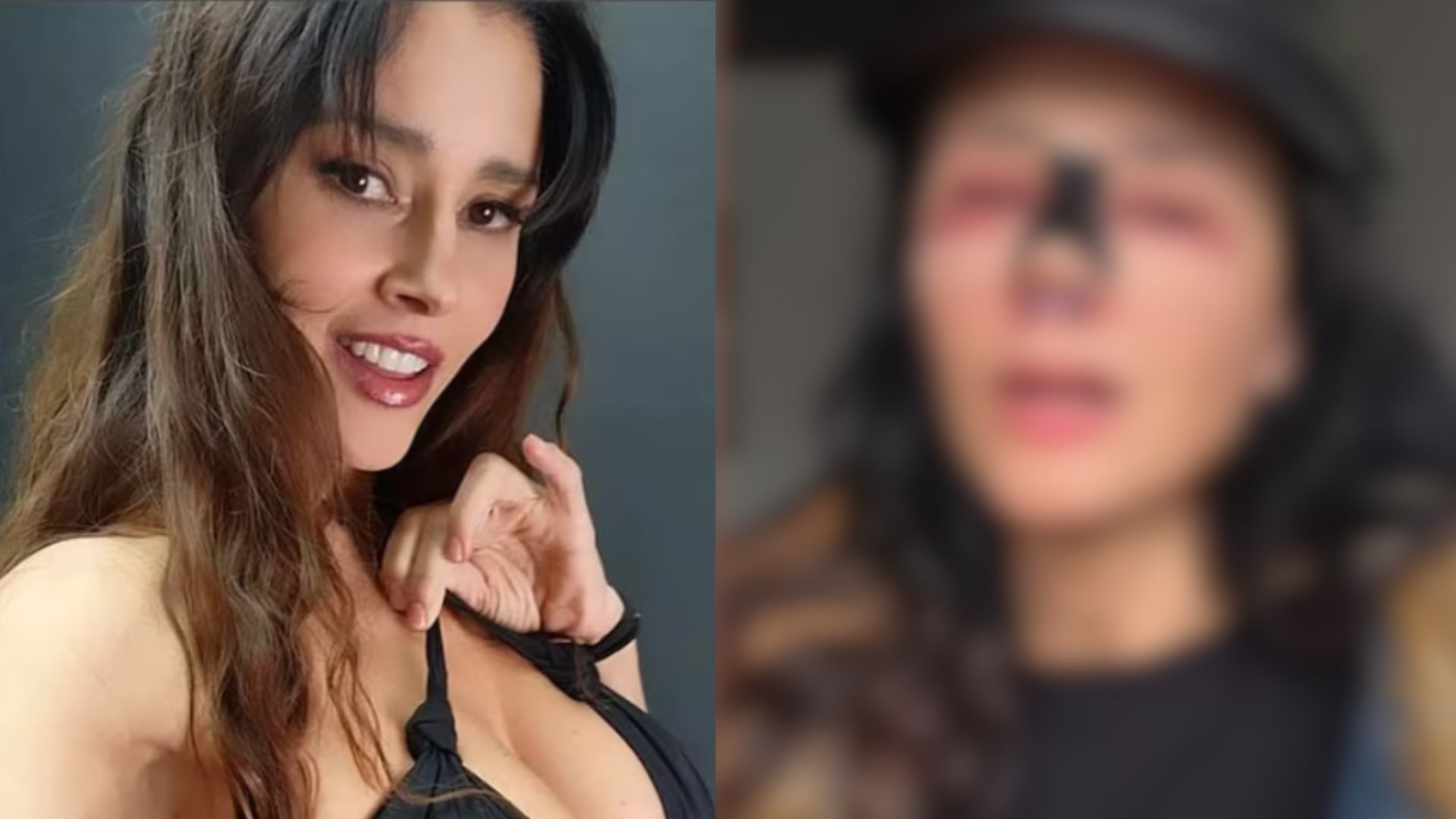 Dorismar muestra su rostro desfigurado y cuenta sobre su cirugía