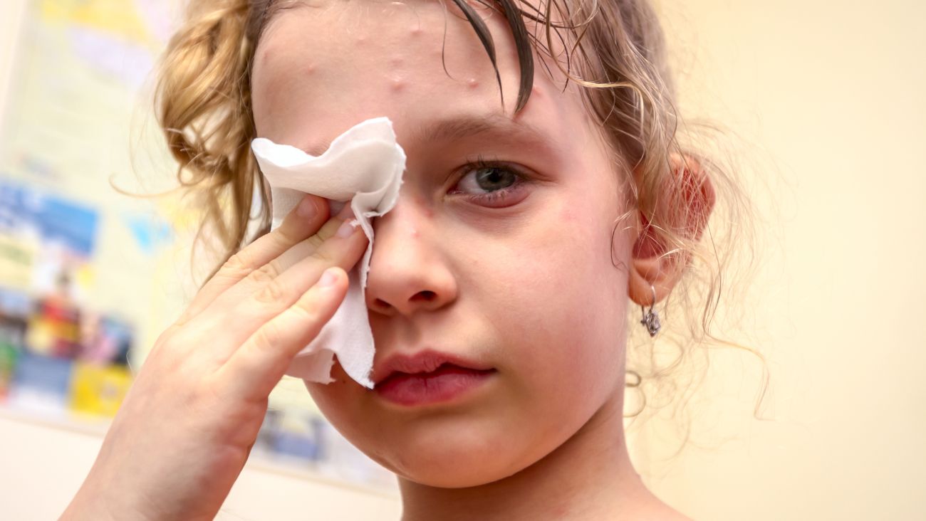 La verdad detrás de la amnesia que provoca el sarampión