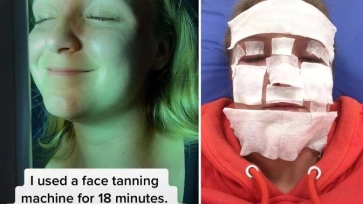 Influencer quemaduras cámara de bronceado