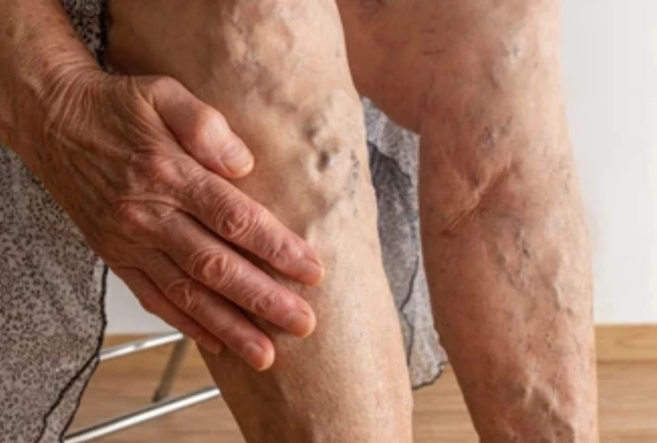 Le REVIENTA una várice y MUERE en su casa; así ocurrió la TRAGEDIA