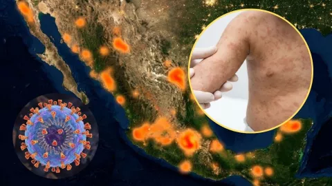 Sarampión en México: por qué explotó el brote en 2026
