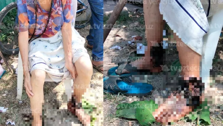 Mujer de la tercera edad es captada con caso activo de gusano barrenador