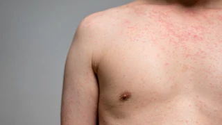 sarampion chihuahua.jpg