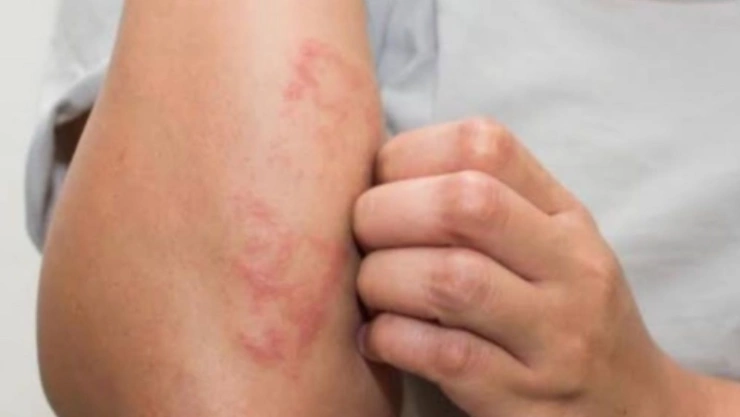 La lepra puede causar lesiones progresivas y permanentes en la piel, los nervios, las extremidades y los ojos.