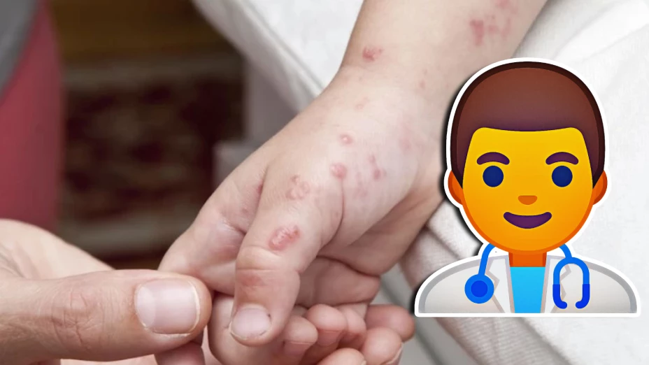 ¿Qué es el virus Coxsackie y cómo afecta a los menores de edad_ Aquí te decimos cómo prevenirla y los síntomas.jpg