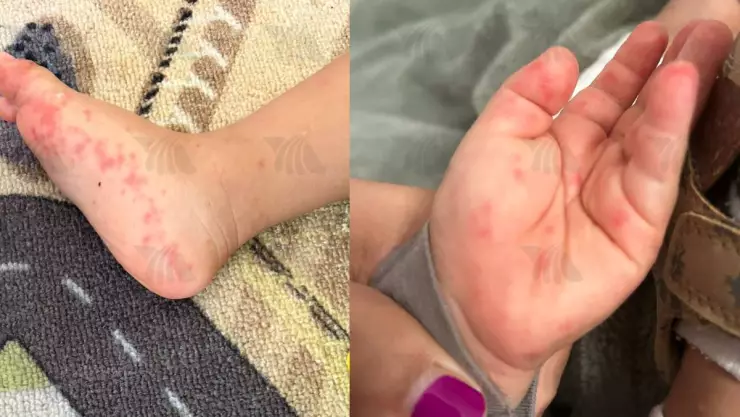 Repuntan casos de mano, pie, boca en niños de Yucatán; estos son los síntomas