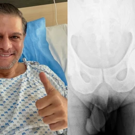 La cirugía de cadera que marcó a Rafa Mercadante: ¿qué le sucedió al actor?