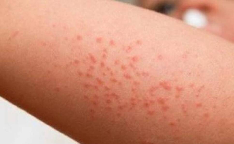 Detectan primer caso de niño con virus de coxsackie en Edomex (2)