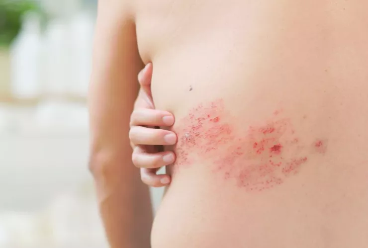 Síntomas y cómo se contagia el herpes zóster