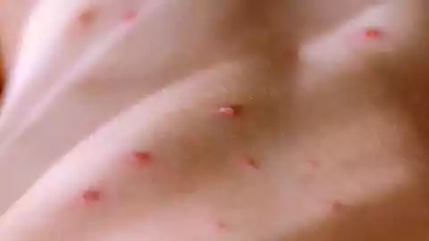 Reportan segundo caso de viruela del mono en Quintana Roo