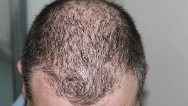pastilla alopecia FDA