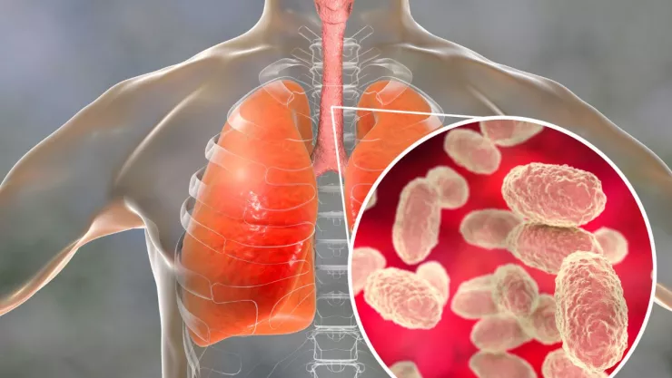 Enfermedad de los 100 días en México 