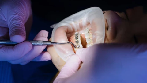 brackets falsos tiktok.jpg