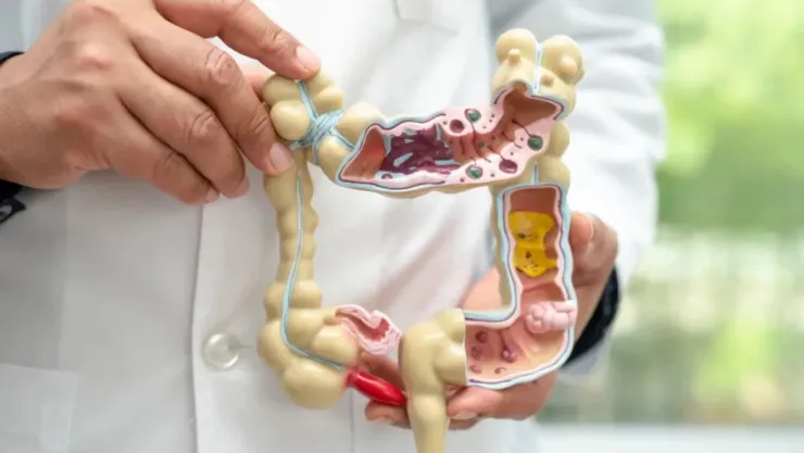 ¿Vives con el colon inflamado?