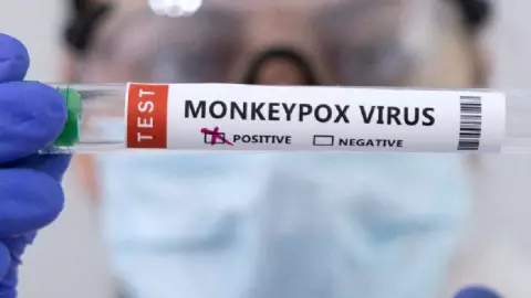 Detectan primer caso de viruela de mono en Querétaro