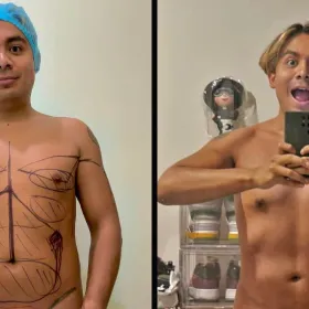 ricardo-peralta.liposuccion-antes-despues.jpg