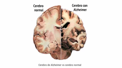 Un cerebro con Alzheimer disminuye su peso y su volumen.