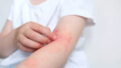 Sarampión_ ¿Cuántas veces te puede dar en la vida