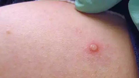 EUA declara emergencia sanitaria nacional por viruela del mono