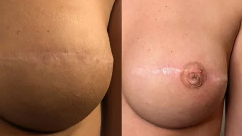 ¿Para qué sirve el tatuaje reconstructivo?