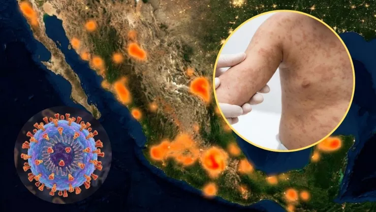 Sarampión en México: por qué explotó el brote en 2026