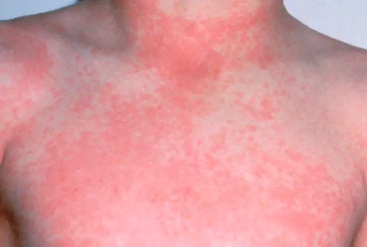 Escarlatina rompe récords en México este 2025: síntomas que debes vigilar