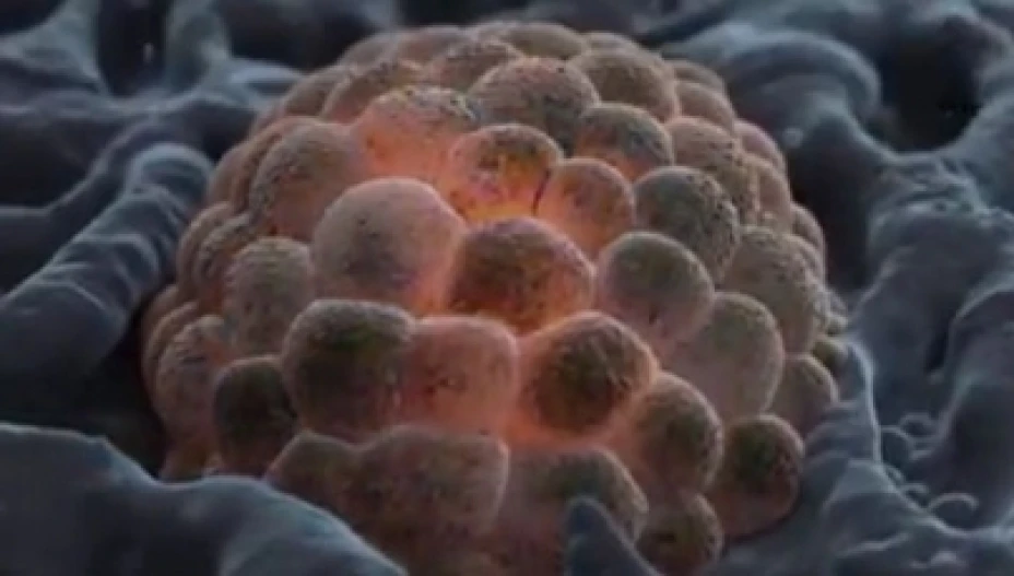 Sarcoma