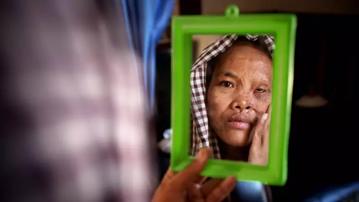 Una mujer que sufrió un ataque con ácido, que no es considerado como delito en muchas partes del mundo.