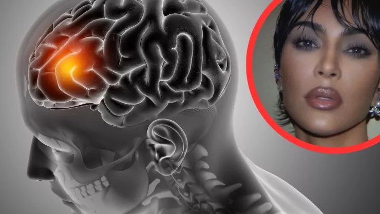 Kim Kardashian informó que fue diagnosticada con un aneurisma cerebral