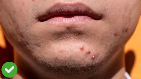 Expertos confirman cuál es el mejor tratamiento contra el acné.jpg