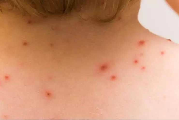 Viruela del mono: Llega el primer caso a Tabasco