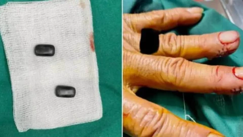 Imanes incrustados en los dedos