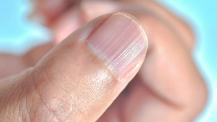 Qué significan las rayas en las uñas y por qué debería preocuparte