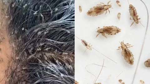 muere por piojos.jpg