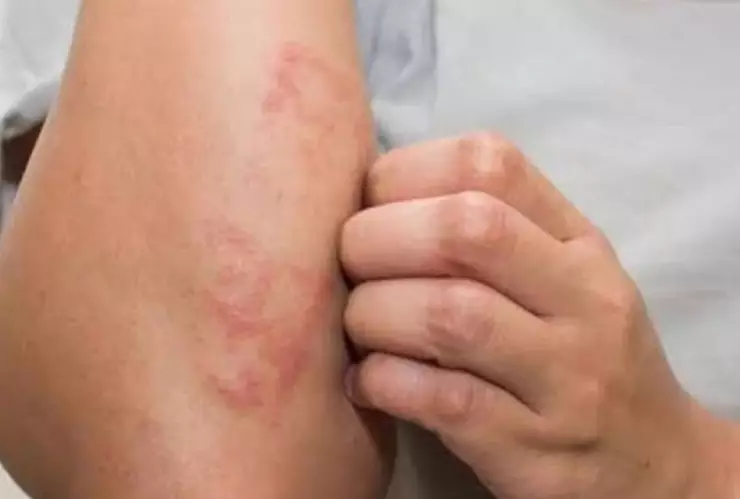 Secretaría de Salud vigila 12 municipios por aumento en casos de lepra