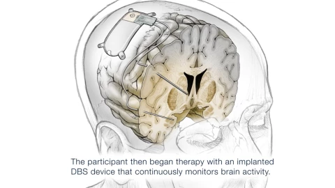 implante_cerebral_depresion