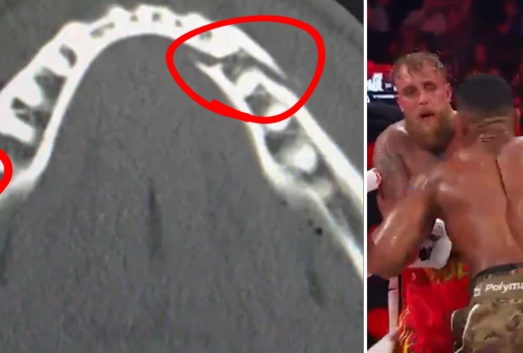 Jake Paul sufre doble fractura de mandíbula.png