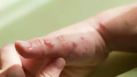 Aumentan los casos de viruela del mono en Qintana roo