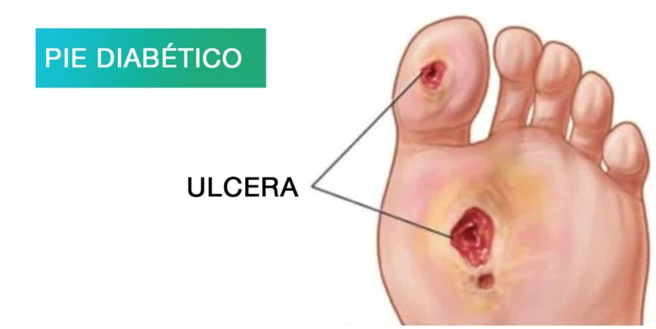 PieDiabético.png