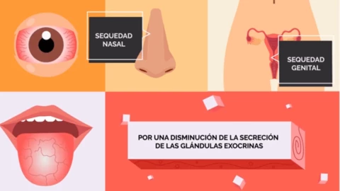 La-sequedad-se-presenta-en-varias-zonas-del-cuerpo-así-es-el-síndrome-de-Sjögren